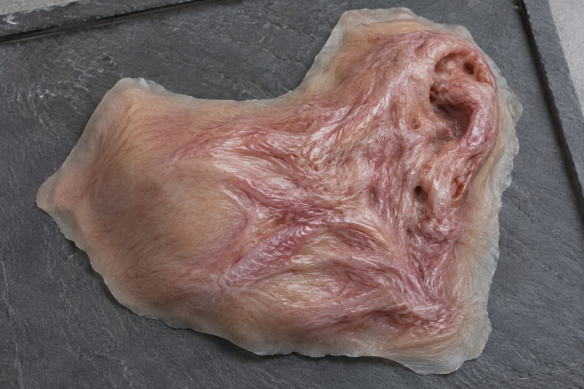 Burn skin, left cheek
